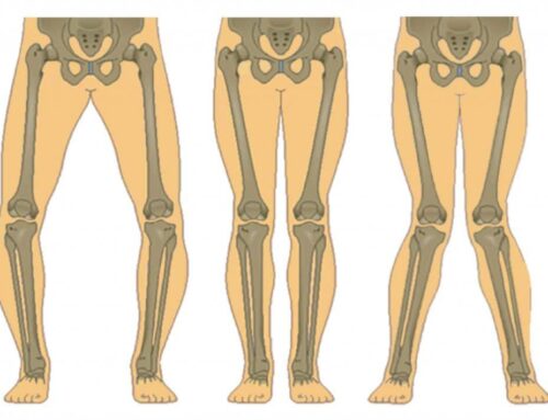 Treatment Options for Children’s Knock Knees and Bowlegs