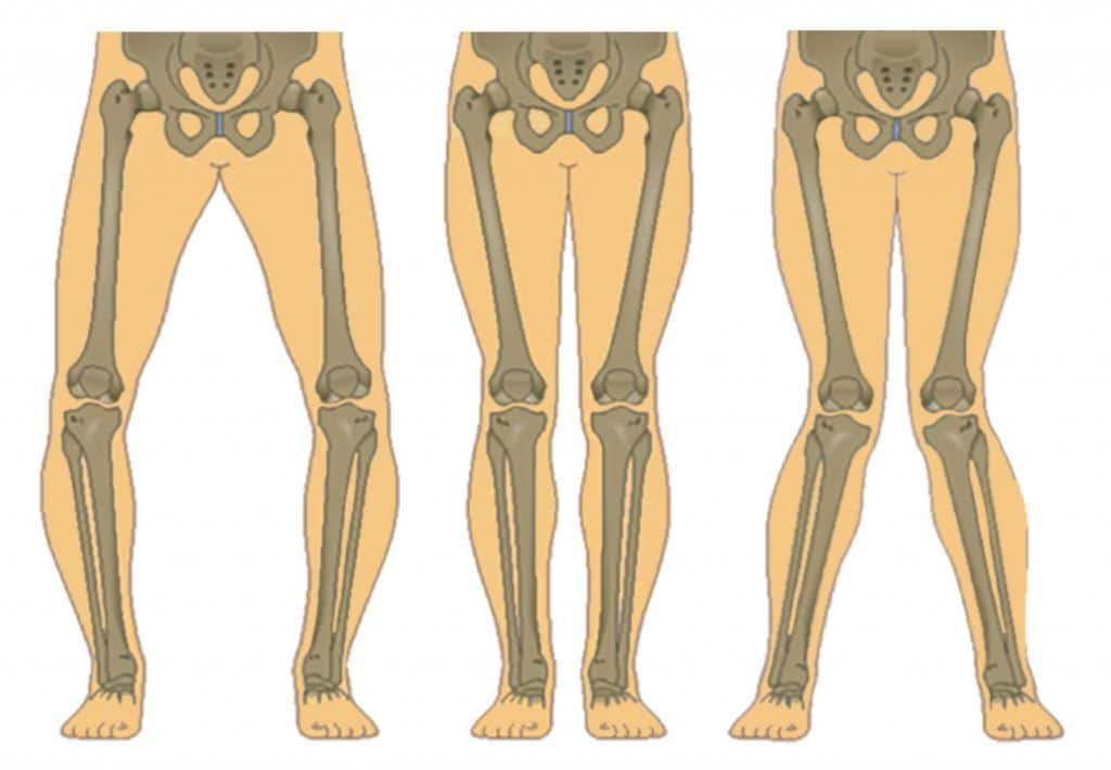 bow-legs-normal-knock-knees-ok-1024×710