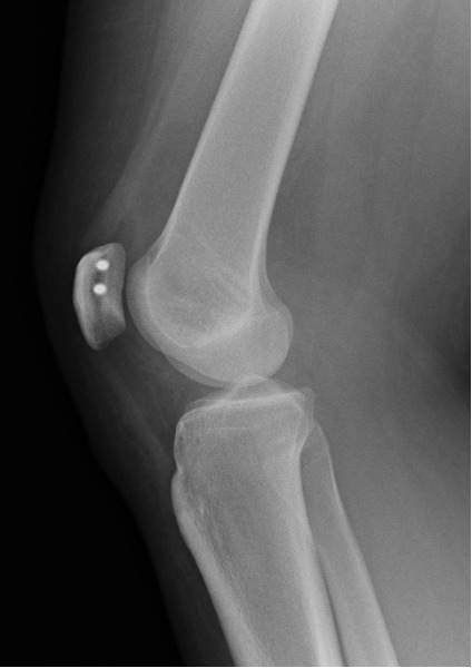 Kneecap Instability Diagram